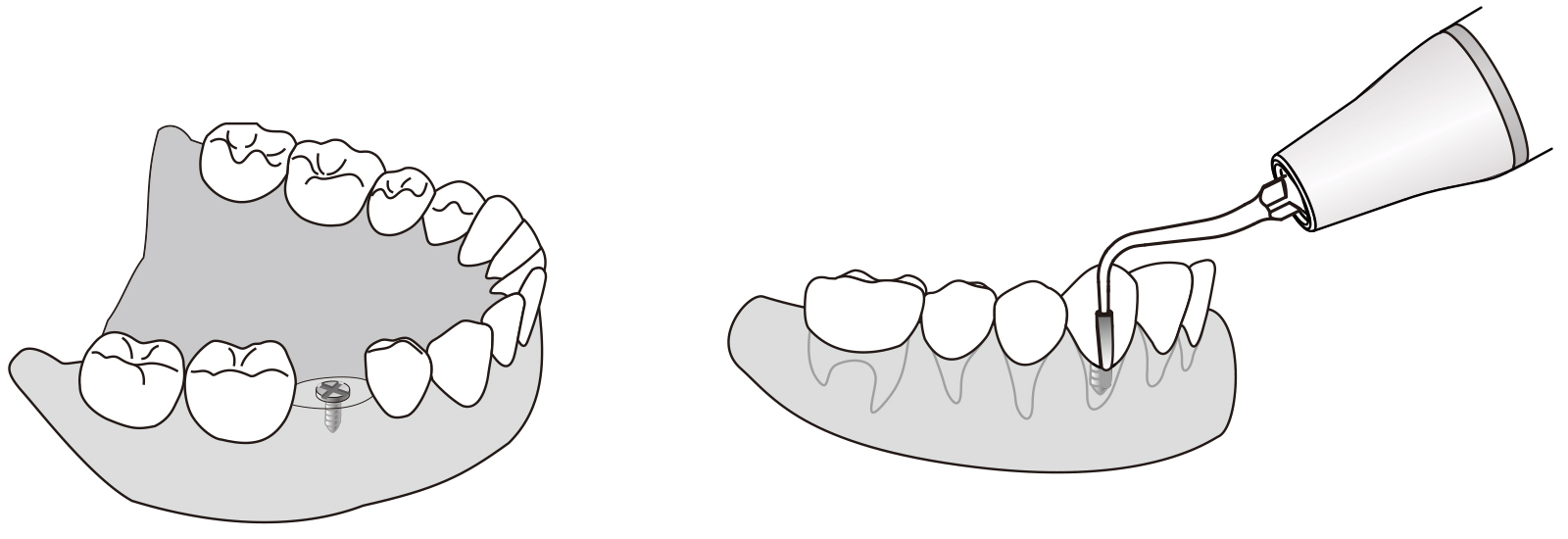 Сфера применения наконечника для скалера